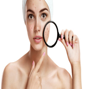 Tratamiento Facial Antiacné - 90 min